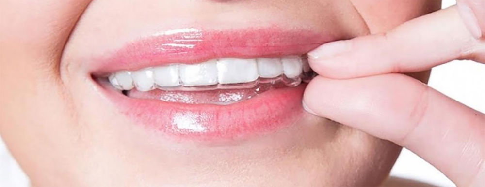 Invisalign thiết kế riêng: Toàn tập về Invisalign