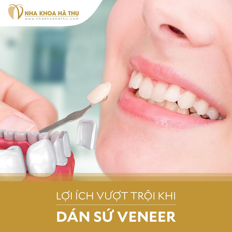 dán sứ veneer