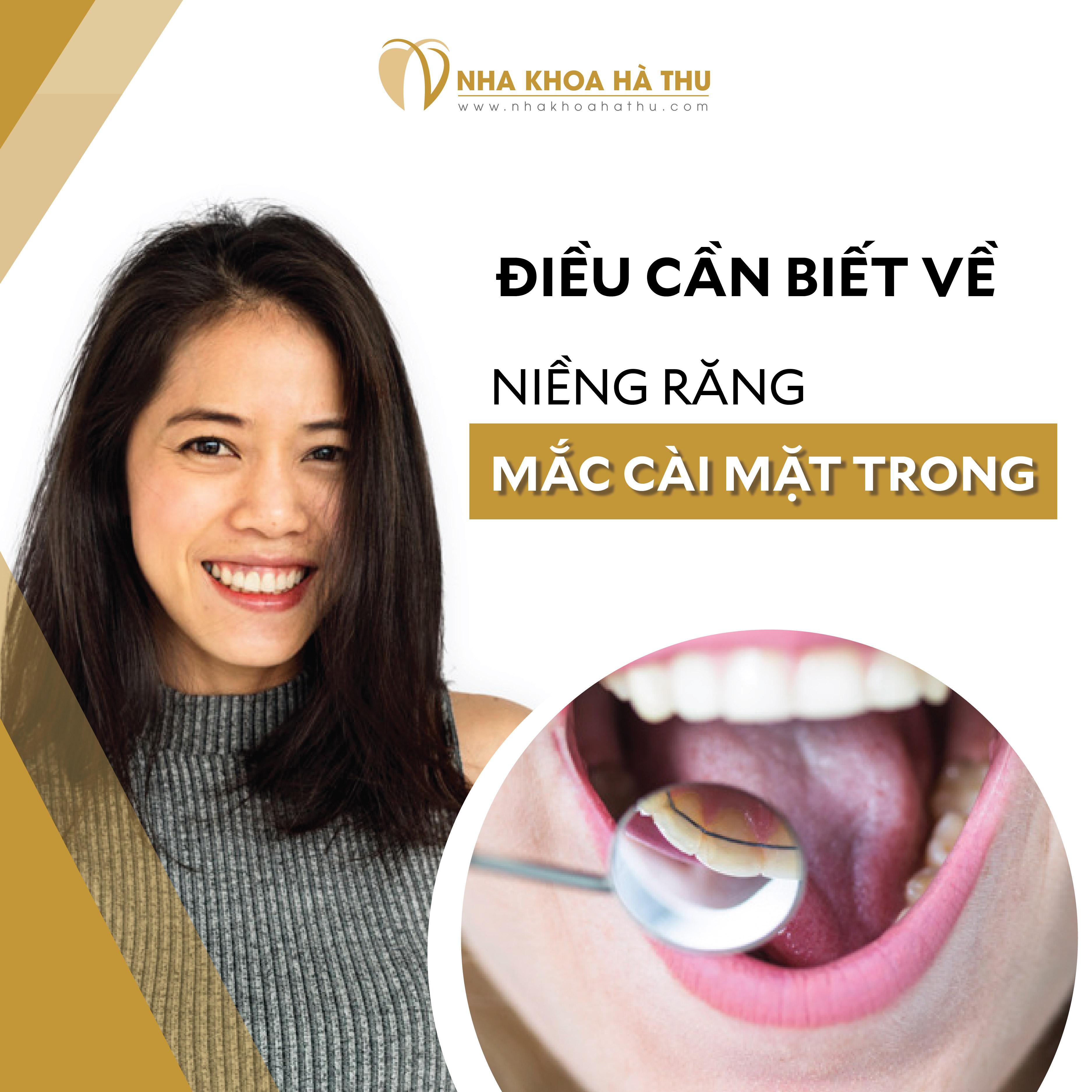 Điều cần biết về niềng răng mắc cài mặt trong