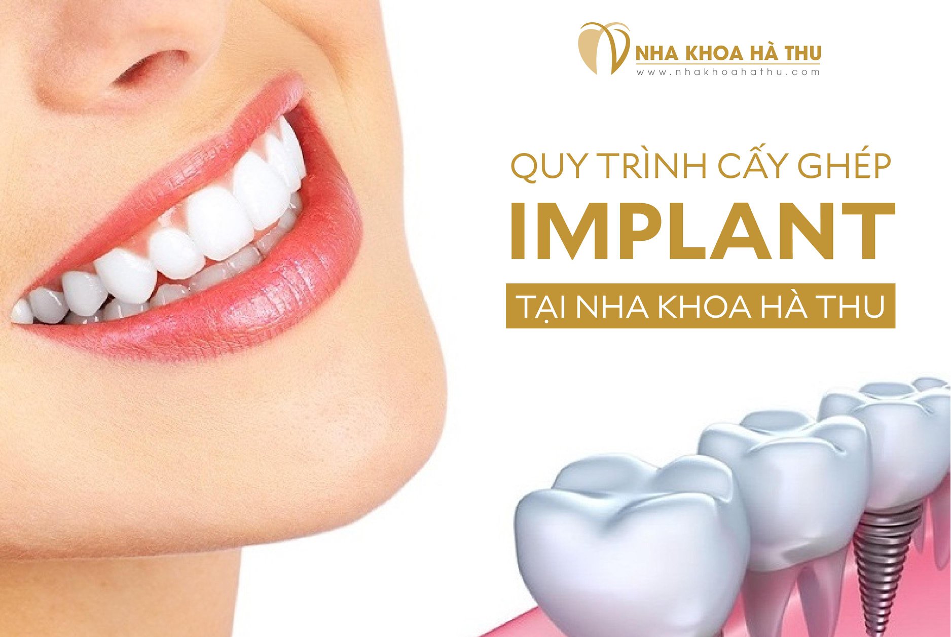 quy trình cấy ghép implant