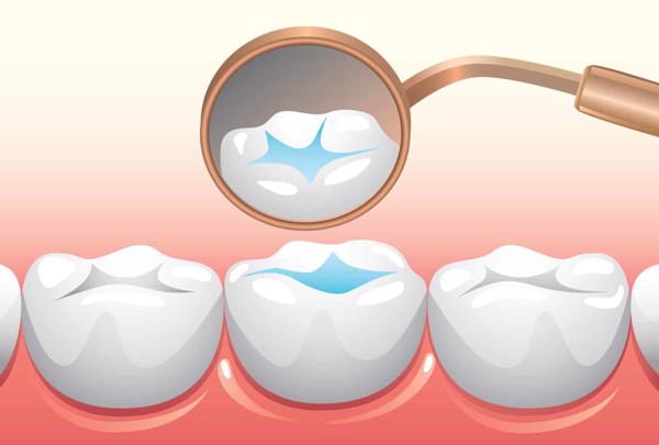Chúng ta nên kiểm tra răng định kỳ thường xuyên để xem sự dính của trám Sealant trên răng còn hay mất.